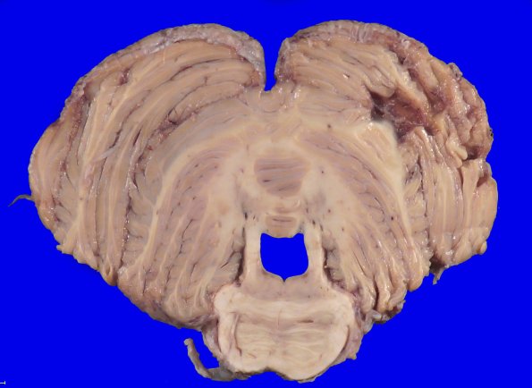 22B9A (Case 22) A.037