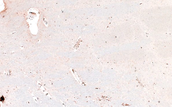 22C6B (Case 22) CD163 4X 3