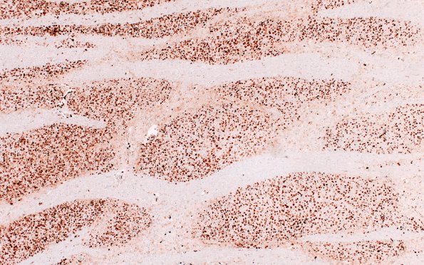22C6C (Case 22) CD163 4X