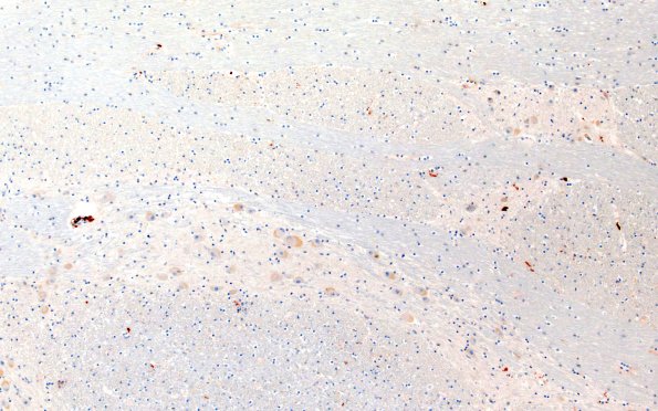 22C6D (Case 22) CD163 10X 2