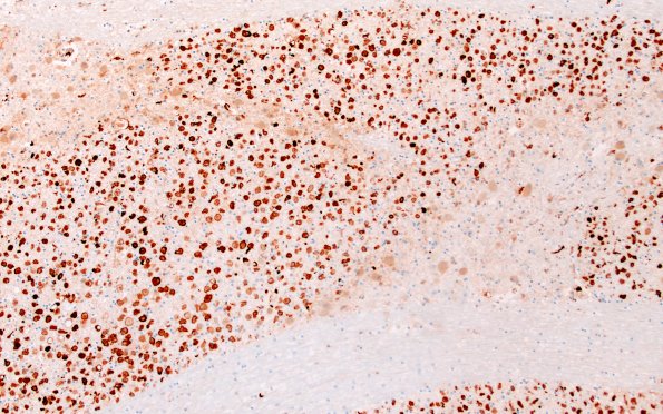 22C6E (Case 22) CD163 10X
