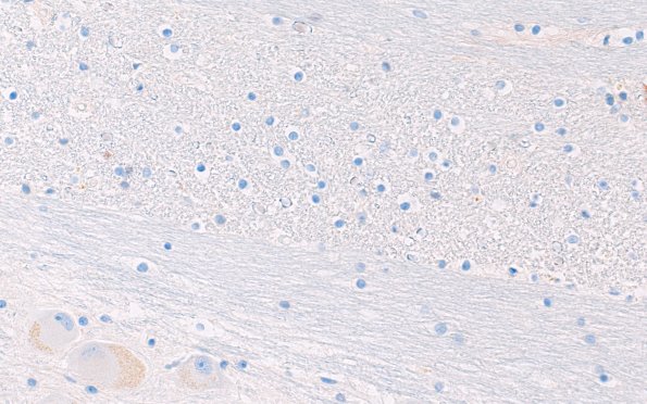 22C6F (Case 22) CD163 40X 2