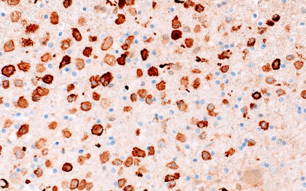 22C6G (Case 22) CD163 40X