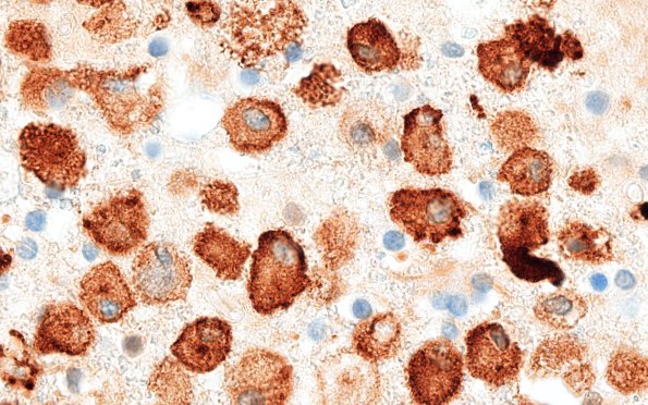 22C6H (Case 22) CD163 100X