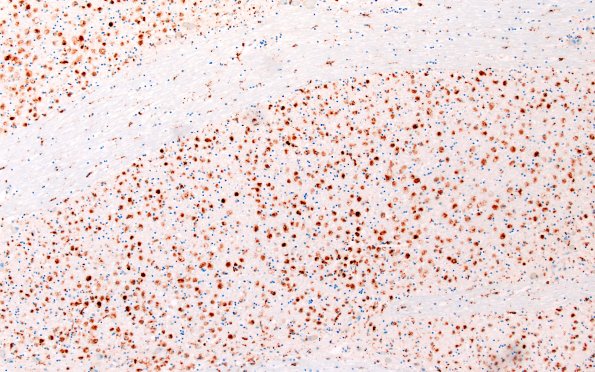22C7A (Case 22) CD68 10X 1