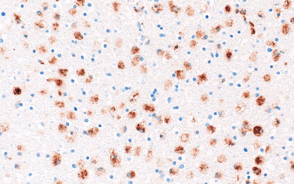22C7B (Case 22) CD68 40X 1