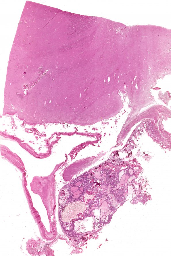 2B1 Craniopharyngioma, adult (Case 2) H&E WM