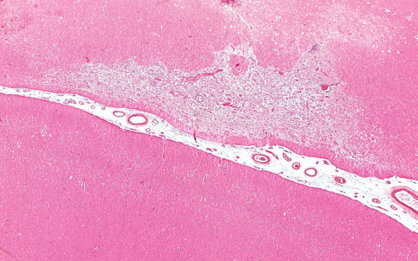 2B2 Craniopharyngioma, adult (Case 2) H&E 2X