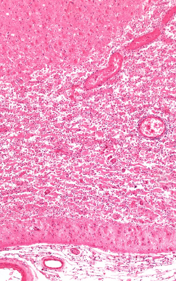 2B3 Craniopharyngioma, adult (Case 2) H&E 10X A