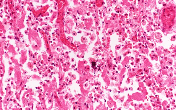 2B4 Craniopharyngioma, adult (Case 2) H&E 40X