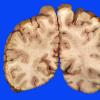 3A Aneurysm, coiled, infarct, subacute (Case 3)_12