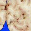 4A Infarct, bilirubin stained (Case 4) gross_2