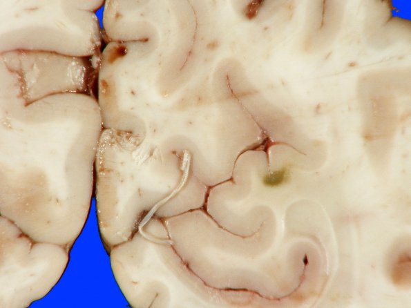 4A Infarct, bilirubin stained (Case 4) gross_2