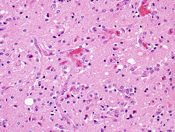 4B2 Infarct, bilirubin stained (Case 4) H&E 2