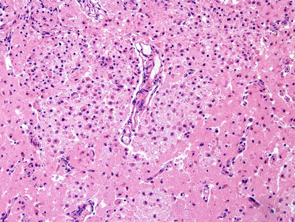 4B3 Infarct, bilirubin stained (Case 4) H&E 3