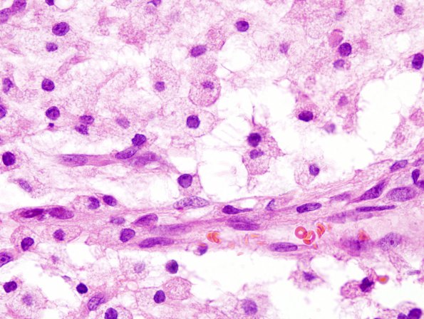 5A2 Macrophages H&E (Case 5) 1