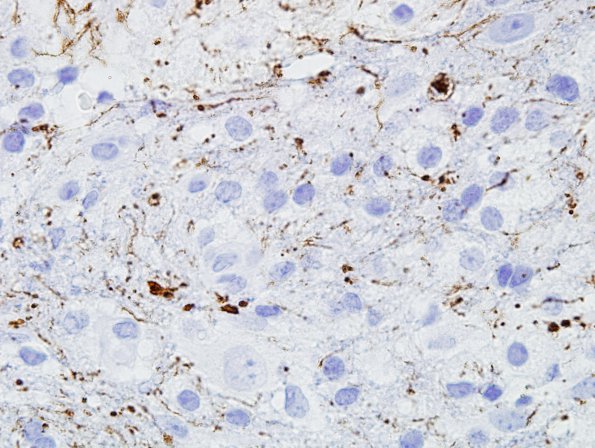 5B1 Infarct compare with Infl Demyel (Case 5) NFil 2