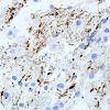 5B2 Infarct compare with Infl Demyel (Case 5) NFil 4