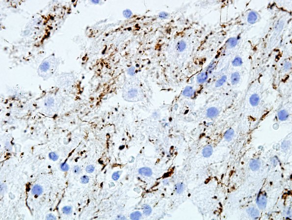 5B2 Infarct compare with Infl Demyel (Case 5) NFil 4