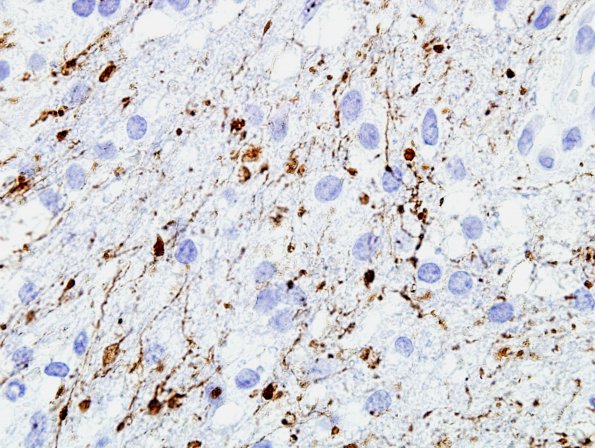 5B3 Infarct compare with Infl Demyel (Case 5) NFil 1