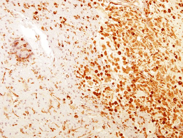 5C1 Infarct compare with Infl Demyel (Case 5) CD68 b