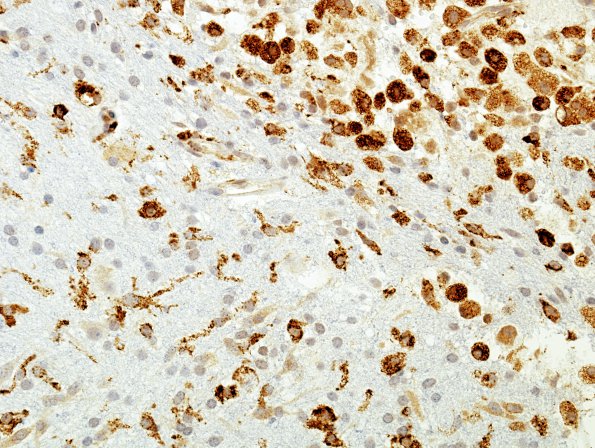 5C2 Infarct compare with Infl Demyel (Case 5) CD68 a