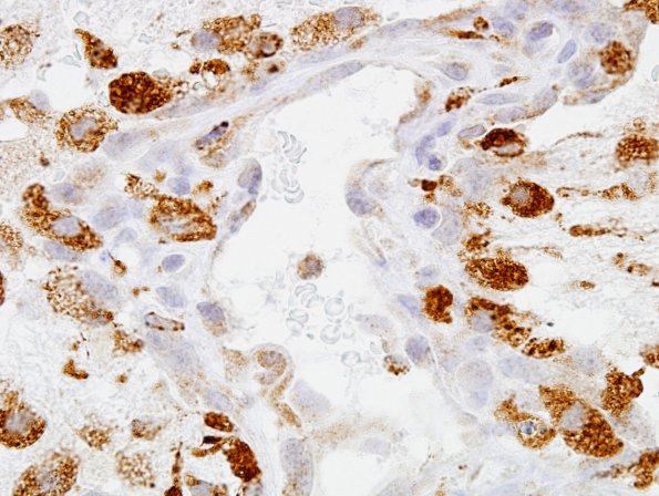 5C3 Infarct compare with Infl Demyel (Case 5) CD68 2