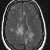 6A1 Infarcts, acute to chronic (Case 6) FLAIR 3 - Copy - Copy