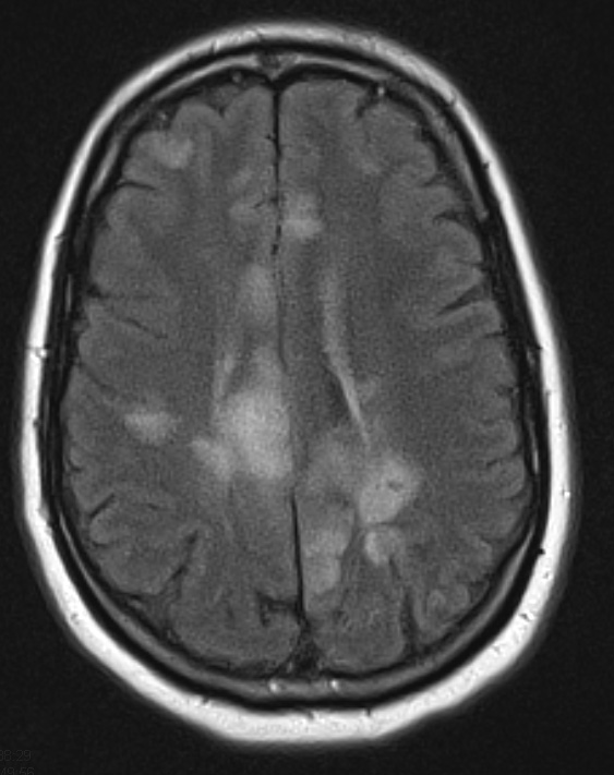 6A1 Infarcts, acute to chronic (Case 6) FLAIR 3 - Copy - Copy