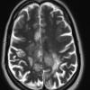 6A2 Infarcts, acute to chronic (Case 6) T2 2 - Copy - Copy