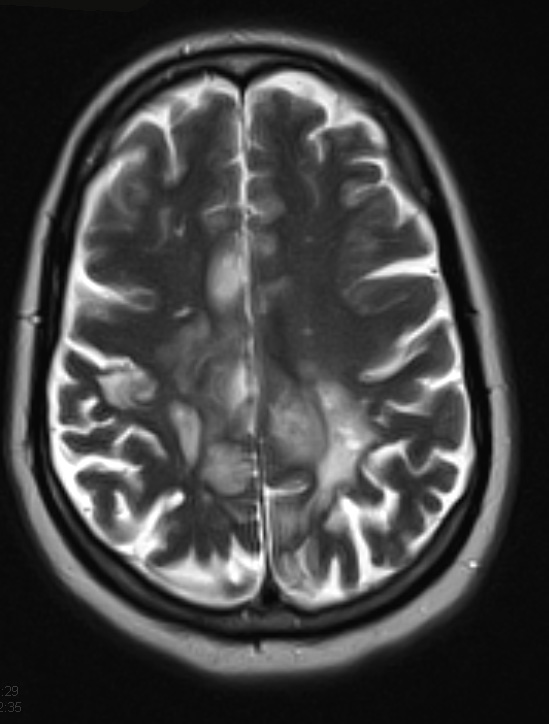 6A2 Infarcts, acute to chronic (Case 6) T2 2 - Copy - Copy