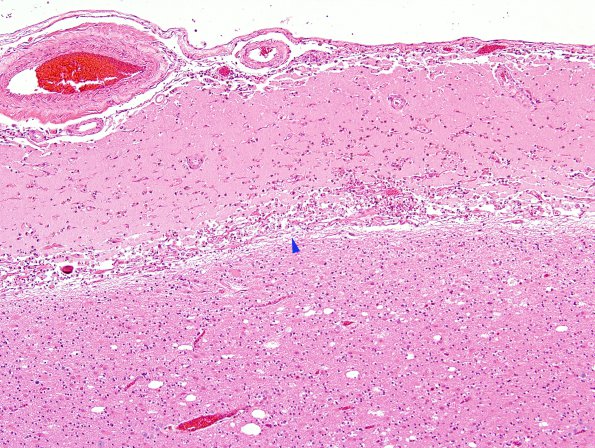 6C2 Infarct, (Case 6)  N19 H&E 9 copy