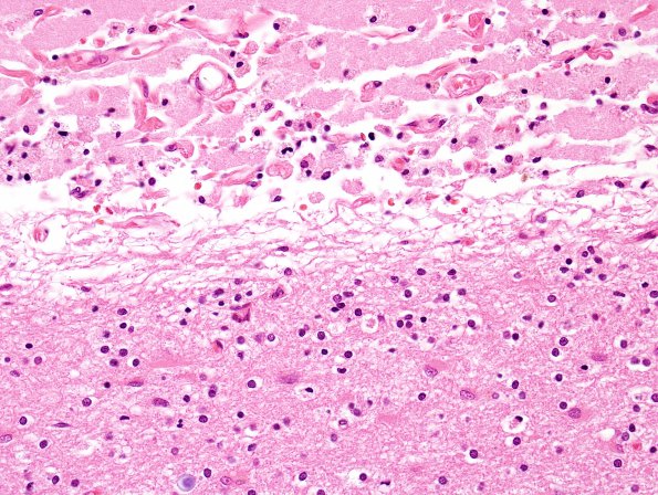 6C3 Infarct, (Case 6)  N19 H&E 2