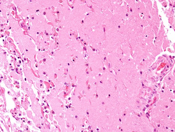 6C4 Infarct  (Case 6)  N19 H&E 3