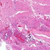 7A1 Infarct, recent-subacute (Case 7) H&E 10X same area