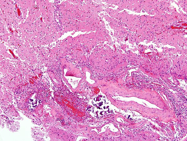 7A1 Infarct, recent-subacute (Case 7) H&E 10X same area