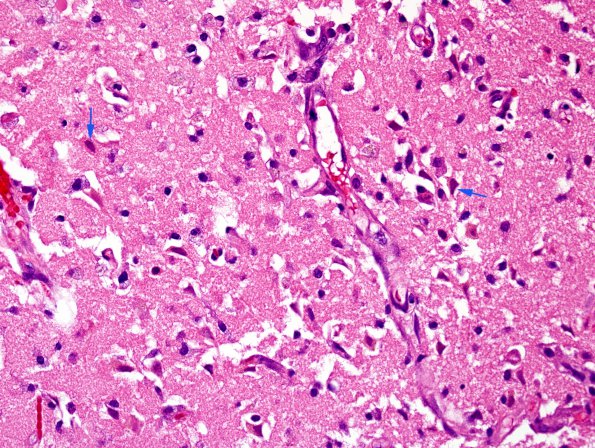 7A2 Infarct, recent-subacute (Case 7) H&E 40X 1 copy