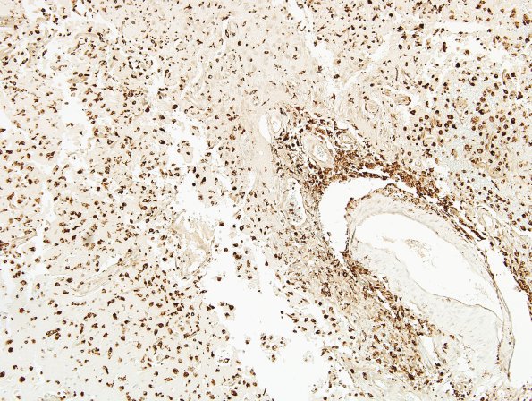 7B Infarct, recent-subacute (Case 7) CD68 10X same area