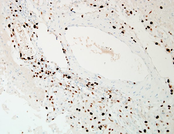 7C Infarct, recent-subacute (Case 7) Ki67 20X same area