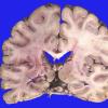 8A Infarct-Hypoxia Ischemia, subacute (Case 8) gross copy