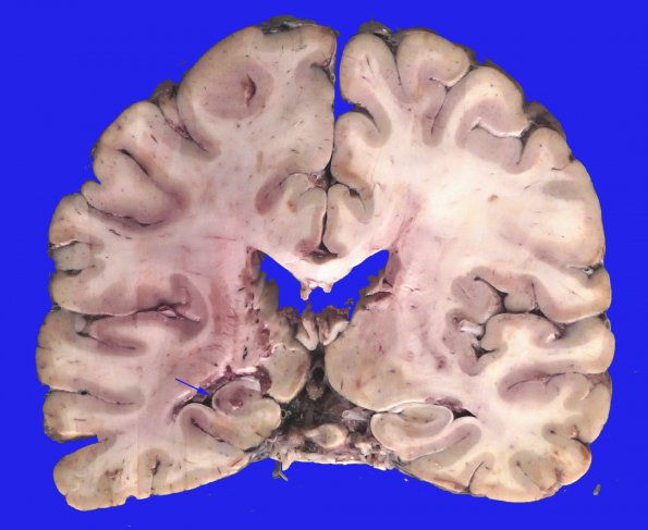 8A Infarct-Hypoxia Ischemia, subacute (Case 8) gross copy