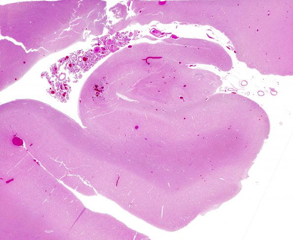 8B1 Infarct-Hypoxia Ischemia, subacute (Case 8) N4 H&E whole mount