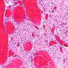 8B3 Infarct-Hypoxia Ischemia, subacute (Case 8) N4 H&E 1 CA1