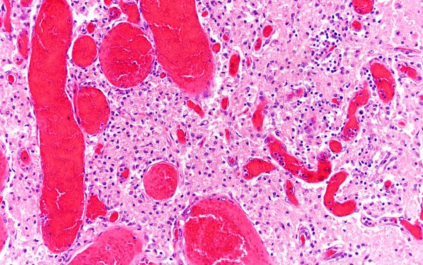 8B3 Infarct-Hypoxia Ischemia, subacute (Case 8) N4 H&E 1 CA1