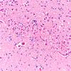 8B4 Infarct-Hypoxia Ischemia, subacute (Case 8) N15 H&E 2 copy