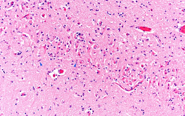 8B4 Infarct-Hypoxia Ischemia, subacute (Case 8) N15 H&E 2 copy