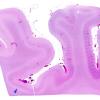 8C1 Infarct-Hypoxia Ischemia, subacute (Case 8) N5 H&E WM copy