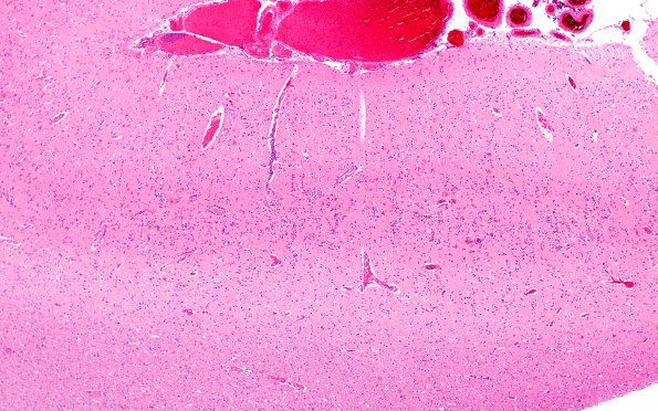 8C3 Infarct-Hypoxia Ischemia, subacute (Case 8) N5 H&E 2