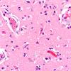 8C4 Infarct-Hypoxia Ischemia, subacute (Case 8) N5 H&E 3