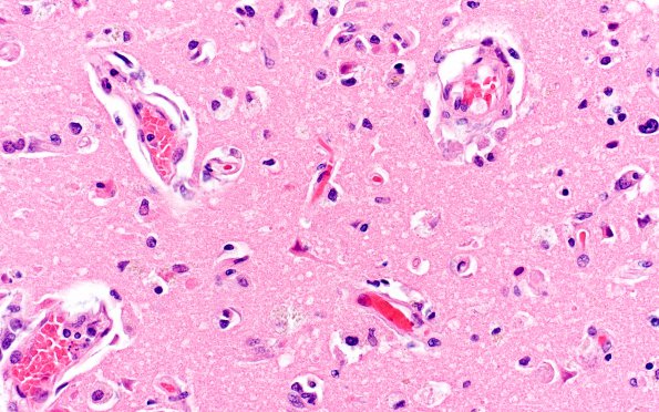 8C4 Infarct-Hypoxia Ischemia, subacute (Case 8) N5 H&E 3